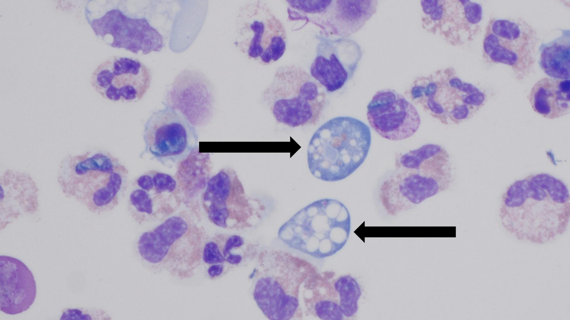 North Carolina teen dies after contracting rare brain-eating amoeba