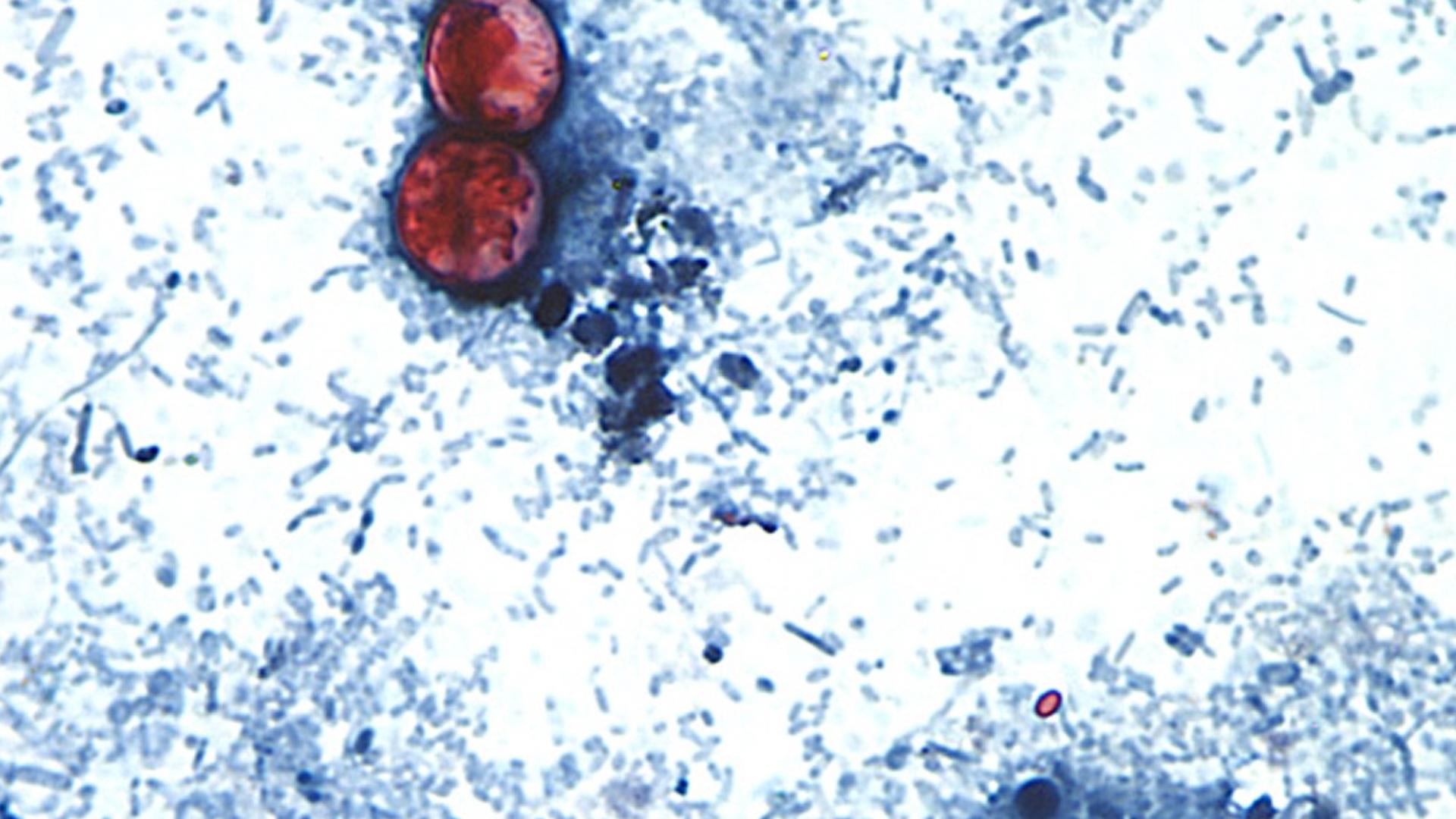 CDC adds 6 new states to Cyclosporiasis outbreak, reports say