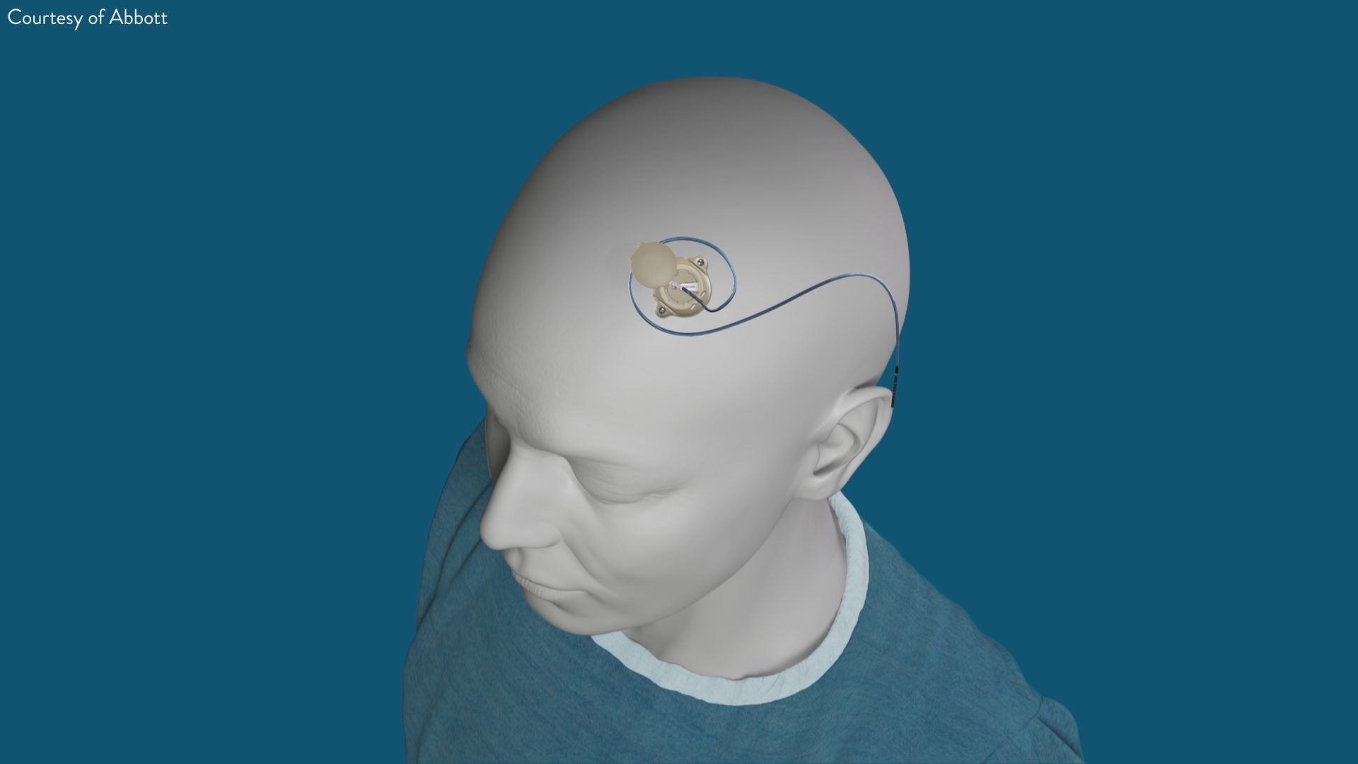 U of M brain implant calms tremors | kare11.com