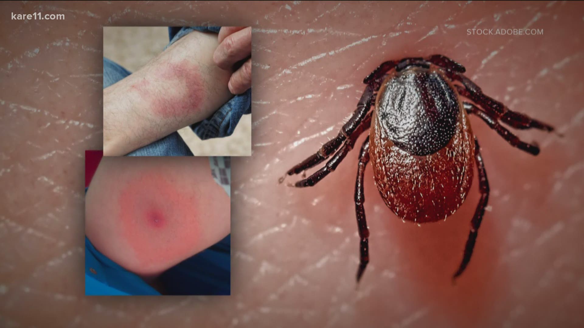 A firefighter went into cardiac arrest, that turned out to be Lyme Disease. Now he's warning others about the dangers.