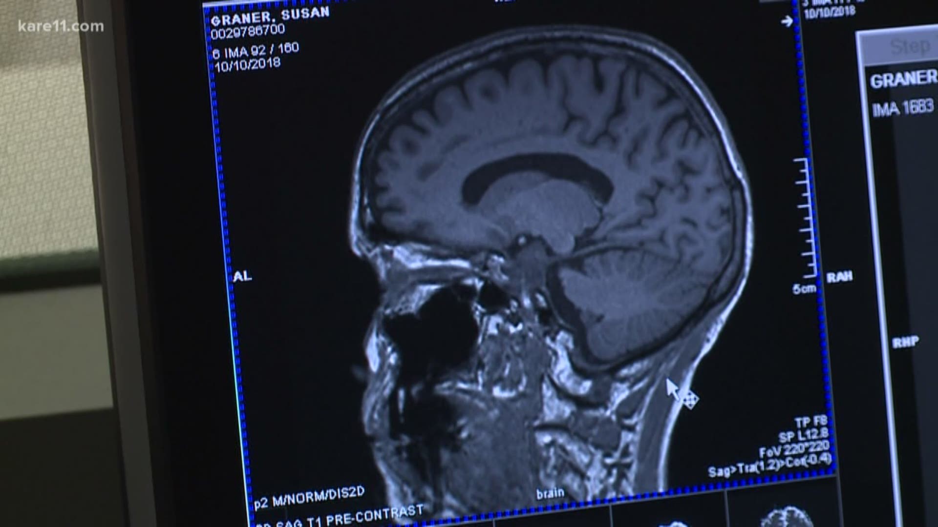A new trial at the University of Minnesota is looking to build on one of the most promising brain cancer treatments in more than a decade.