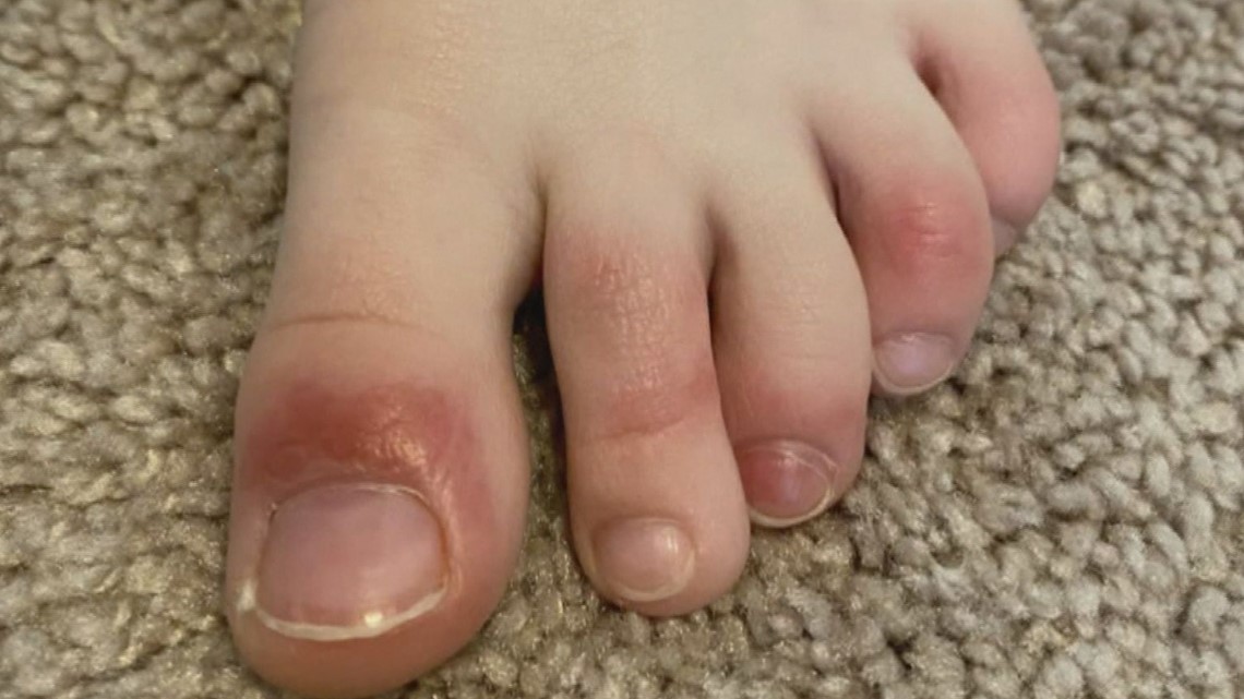 swollen toes from heels