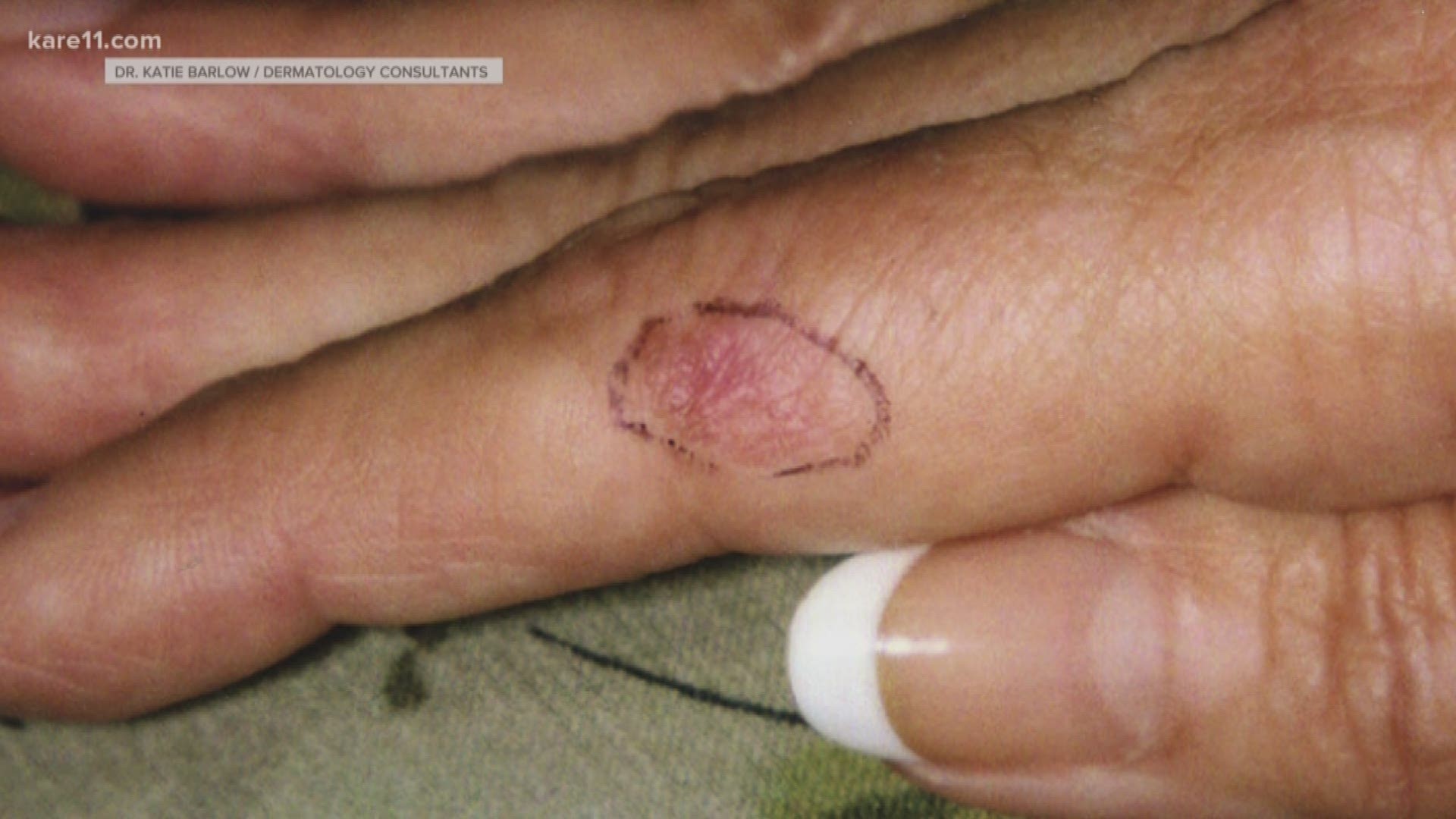 cancer on my finger