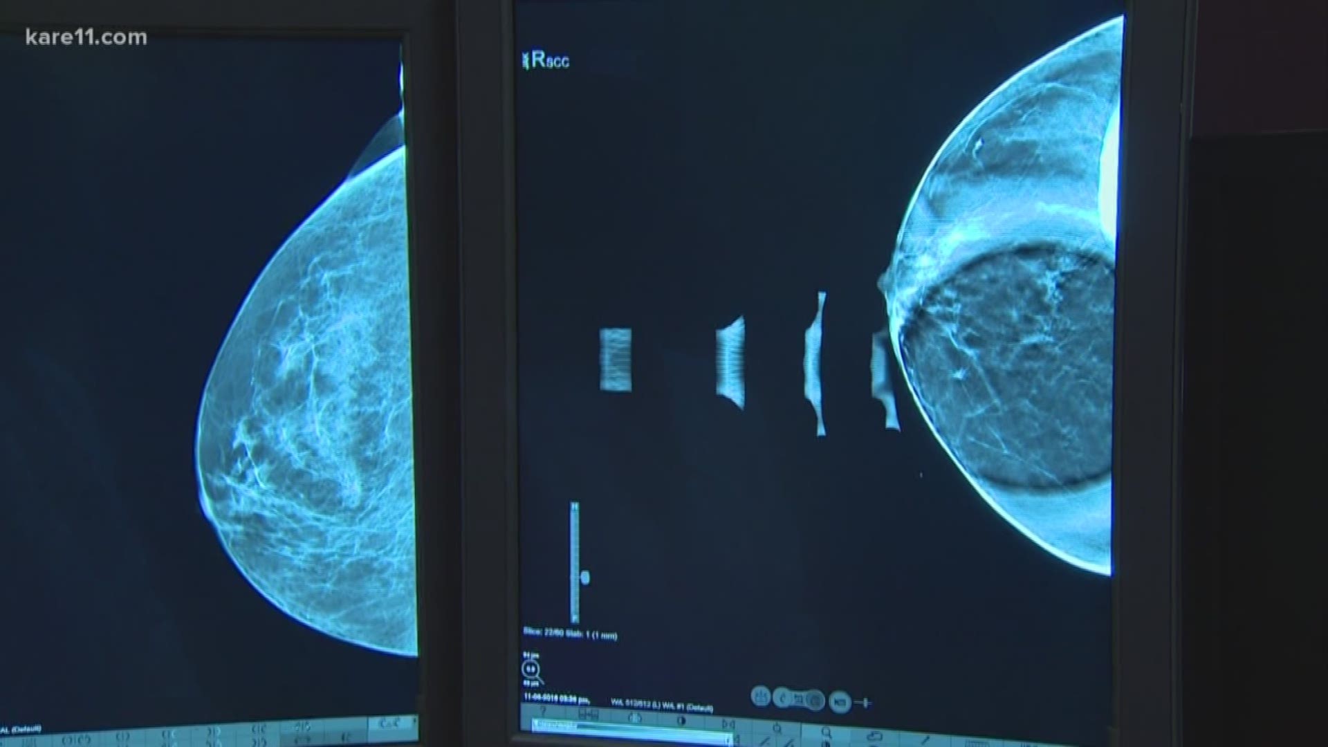 A traditional mammogram, or 2D scan, takes two images of the breast so you get four images total. A 3D scan takes an image every millimeter, which could lead to a couple hundred images.