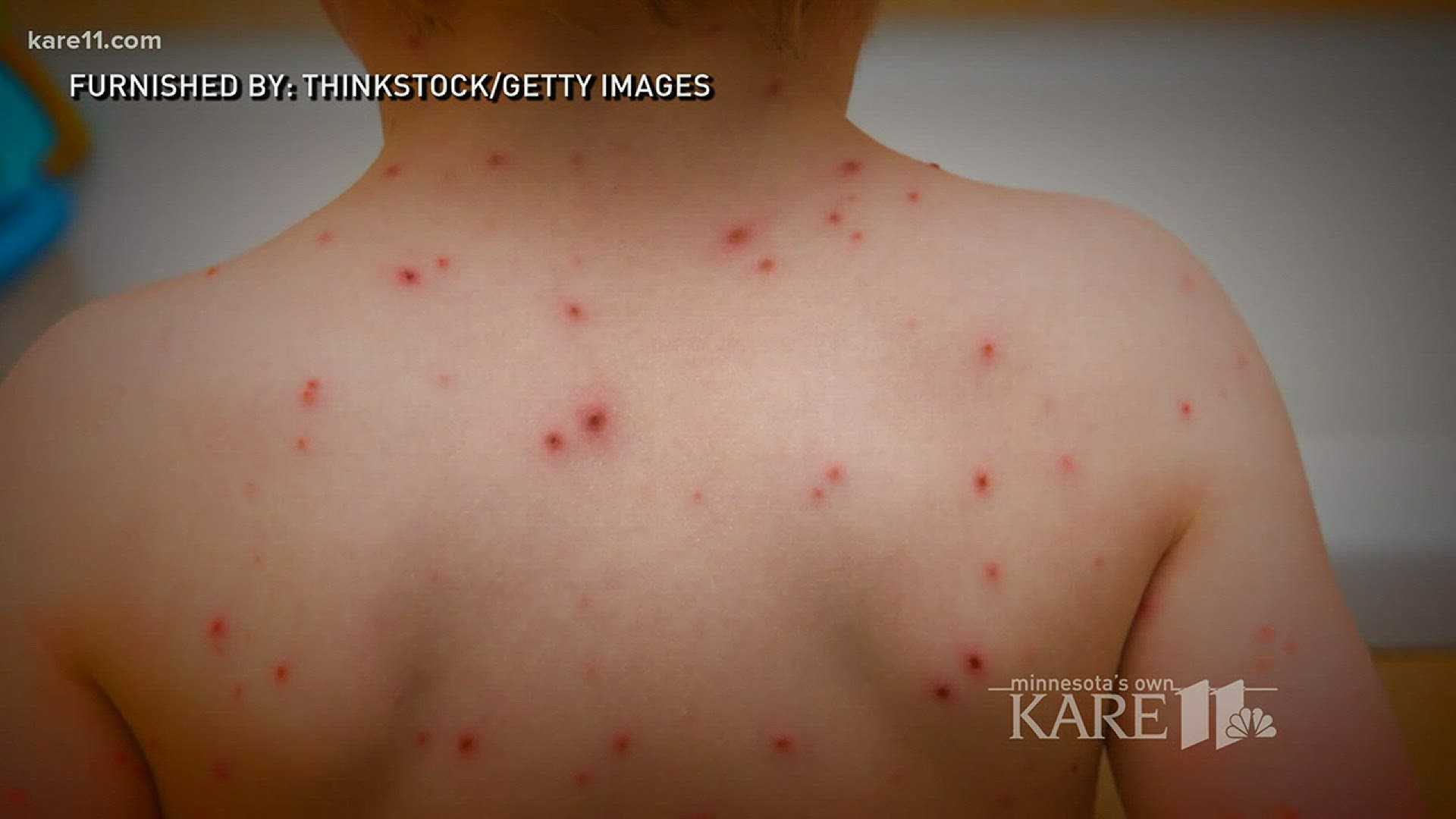 390 cases of chickenpox reported in MN this year