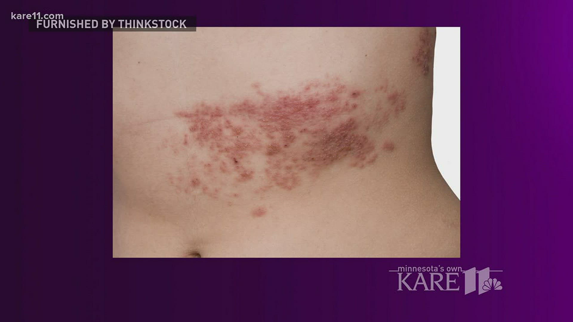 Shingles is caused by a reactivation of the virus that triggers chicken pox, a condition which is extremely painful.