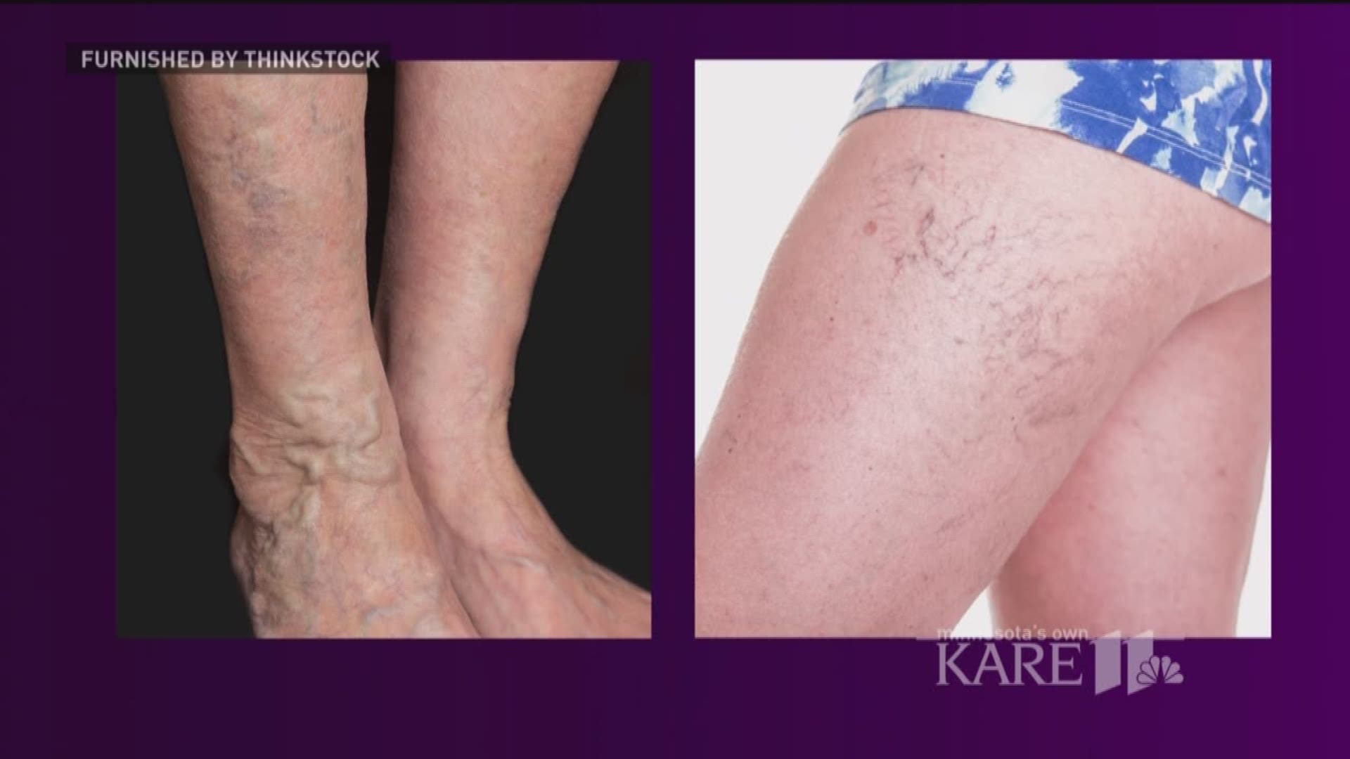 Dr. Joseph Karam, a Vascular Surgeon with the Minneapolis Heart Institute and Allina Health joined us to talk about varicose veins and what they may say about our overall health.