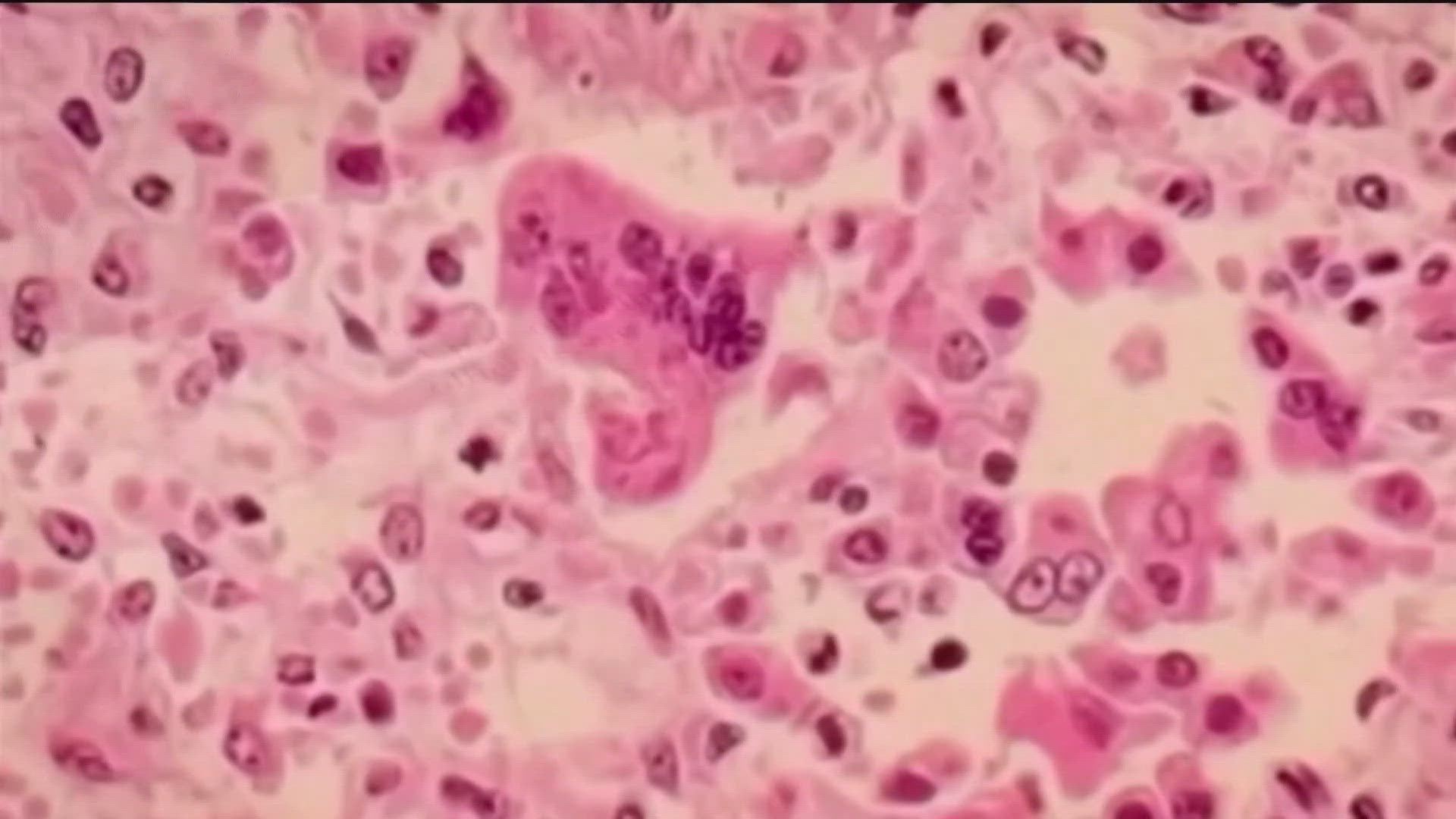 The Minnesota Department of Health confirmed an individual who had been traveling recently returned to Minnesota and tested positive for the measles.