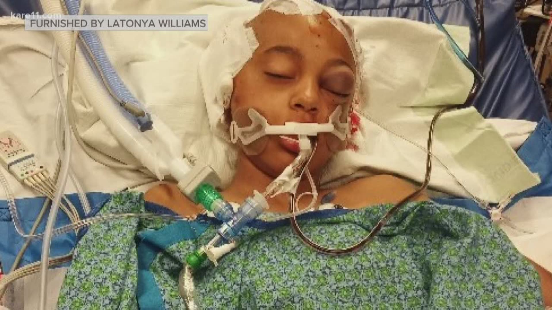 An 11-year-old is still in critical condition after she was hit by a car after getting off a school bus Friday afternoon. https://kare11.tv/2DP2FYc