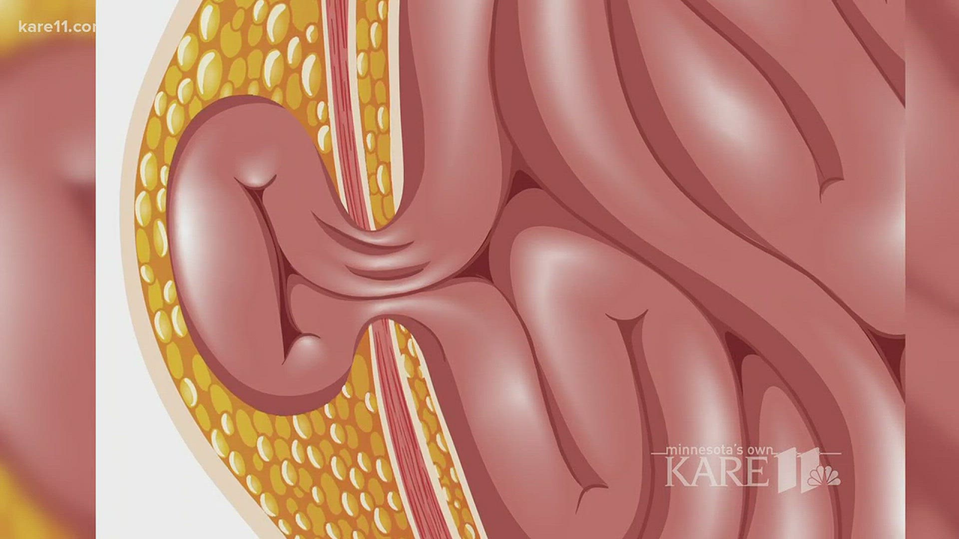 So what exactly is a hernia? http://kare11.tv/2FjNlp9