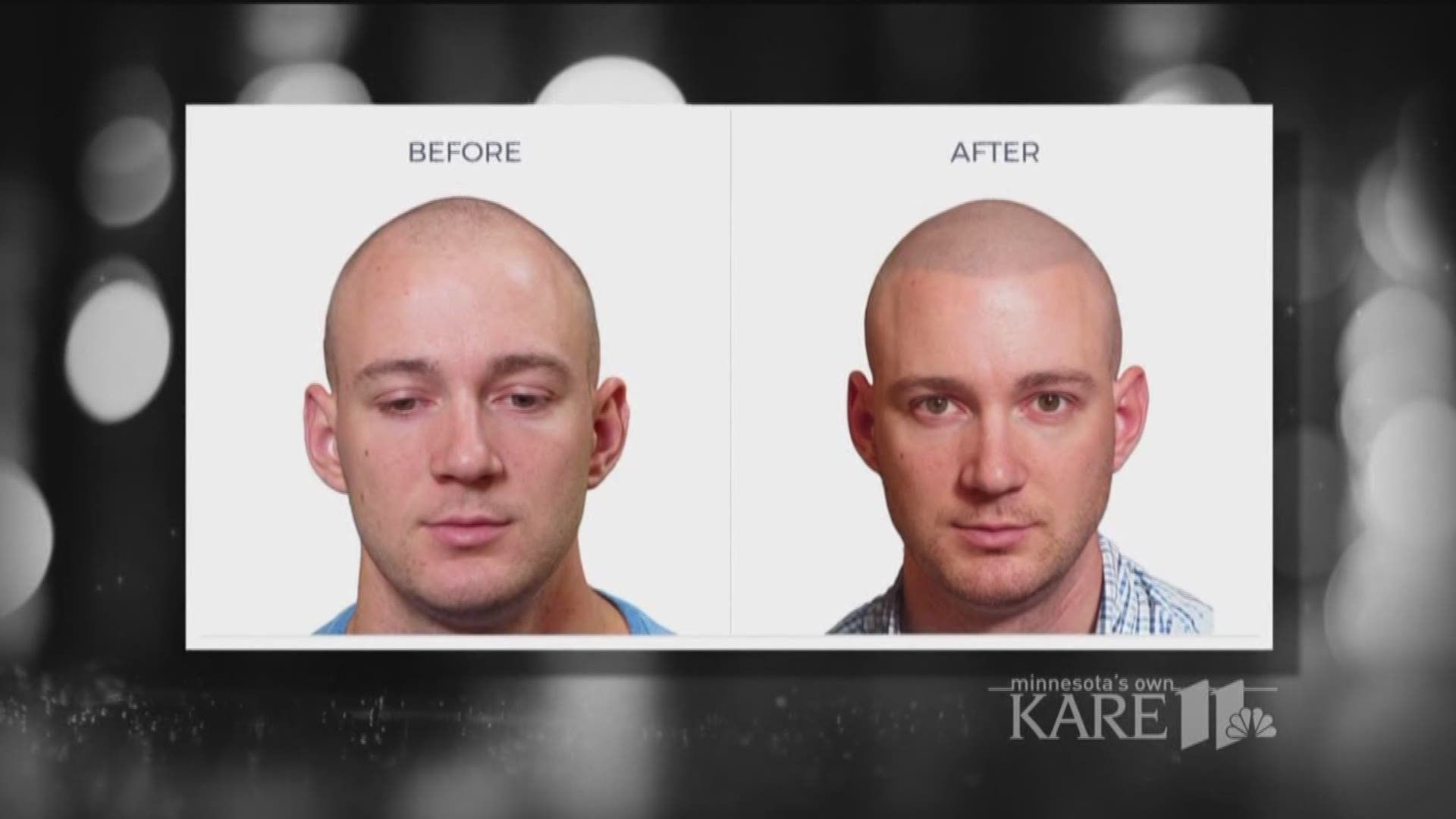 Minnesota business restoring confidence for balding men