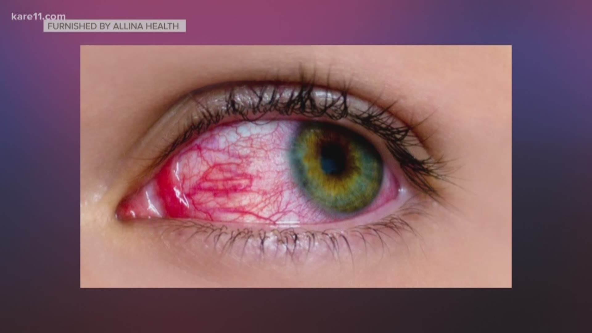 While red, itchy eyes may have you reaching for the eye drops, Allina Health infectious disease specialist Dr. Frank Rhame says prescription drops may not always be the best medicine. https://kare11.tv/2svUF8p