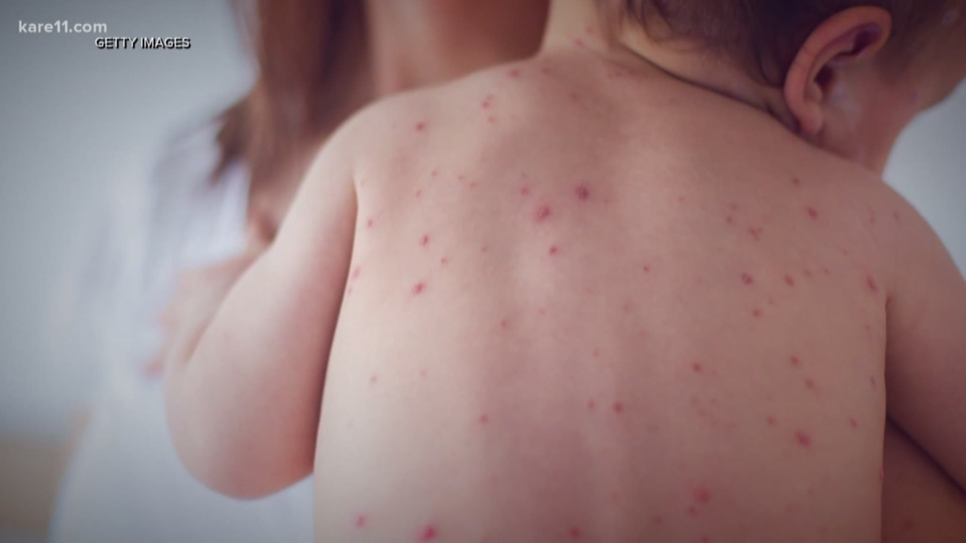 The number of confirmed measles cases in the U.S. has now climbed to 764 – that’s more than double the number a year ago and the highest total in 25 years, according to new numbers released today by the Centers for Disease Control and Prevention.