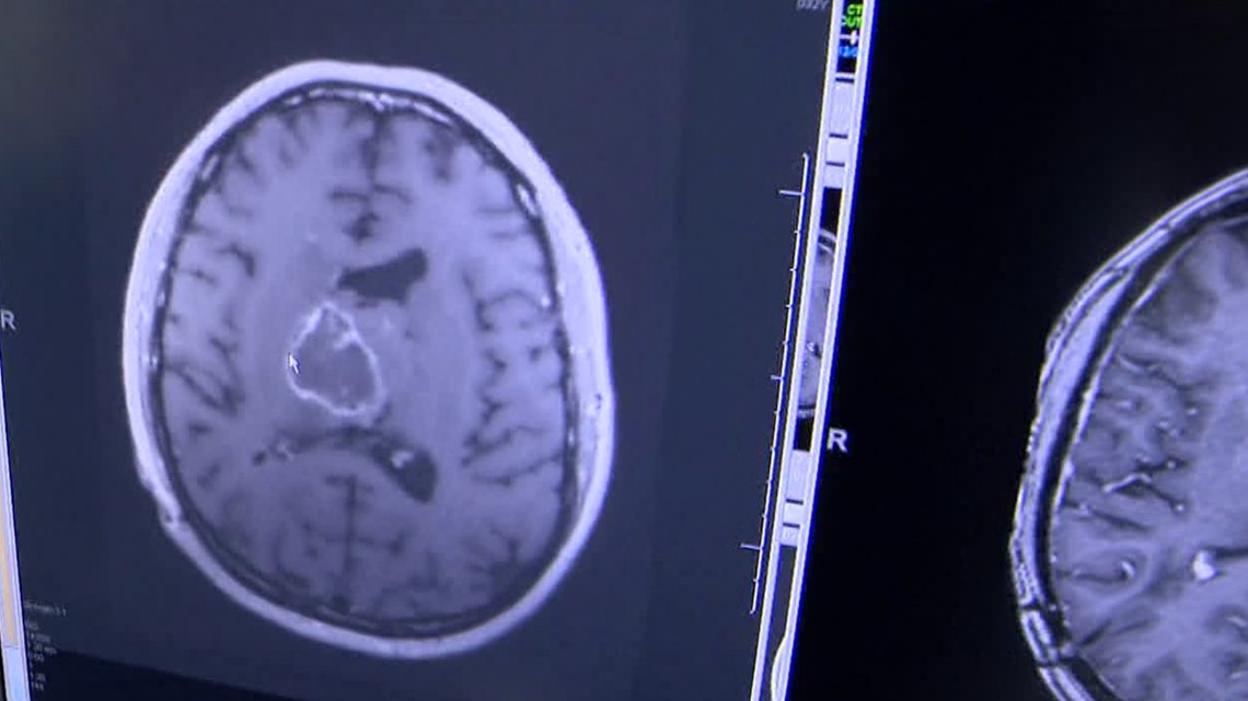 Brain cancer drug trial set to expand at University of Minnesota - Vimarsana News