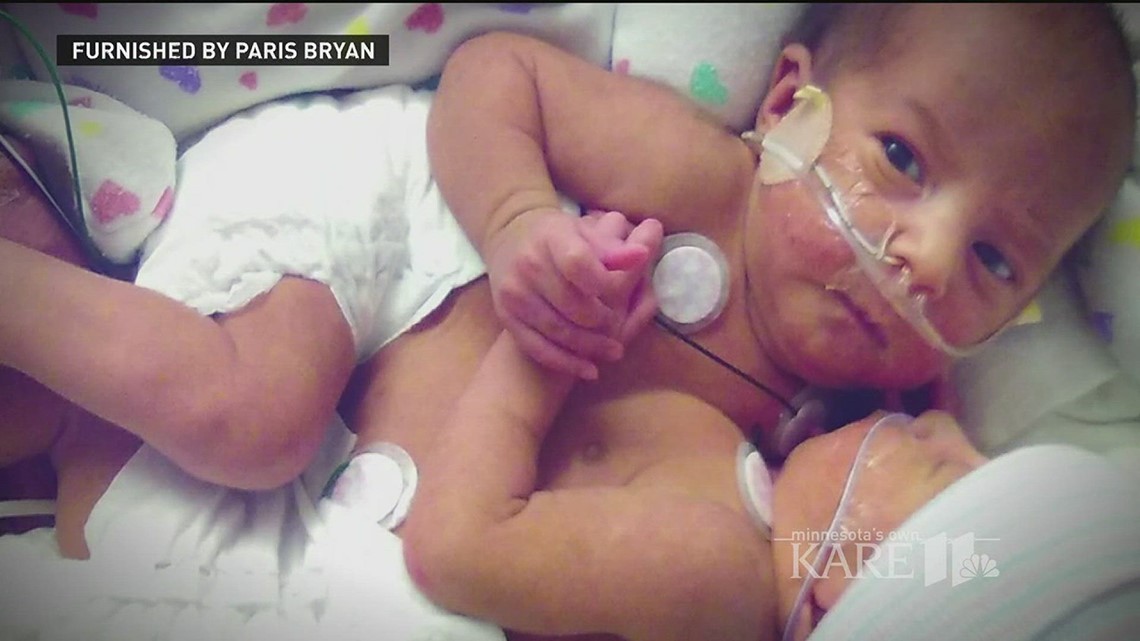 Conjoined twins separated with help of 3D technology | kare11.com