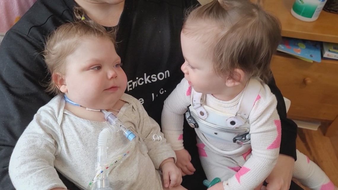 Elk River family searches for nurse for formerly conjoined twin - Vimarsana News