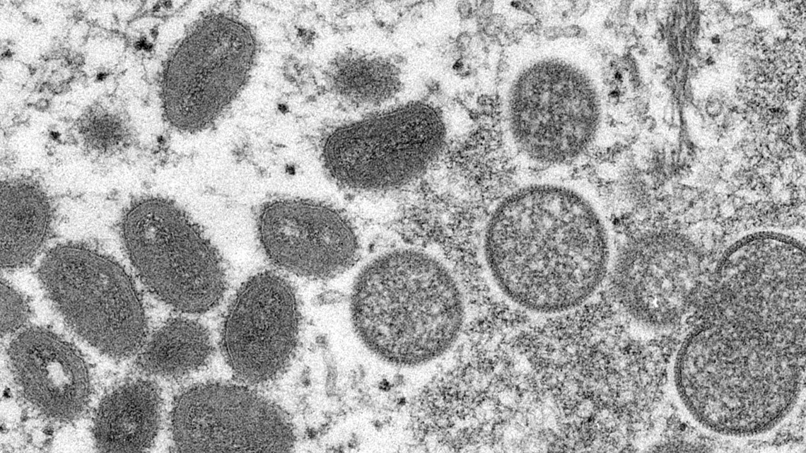 Monkeypox could become an endemic STD in the US - Vimarsana News