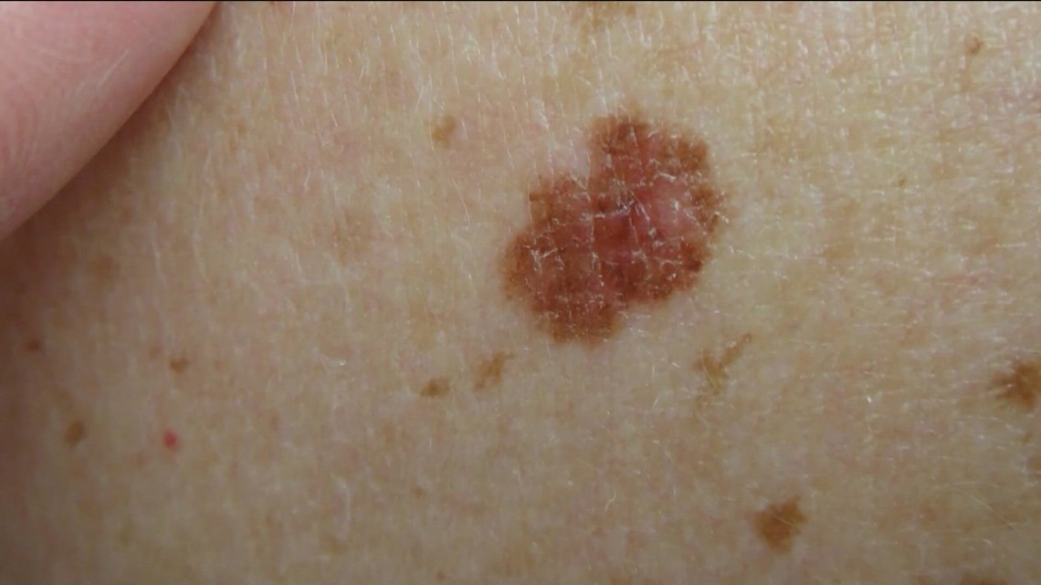 Study shows personalized mRNA vaccine cuts melanoma recurrence risk in half after five years
