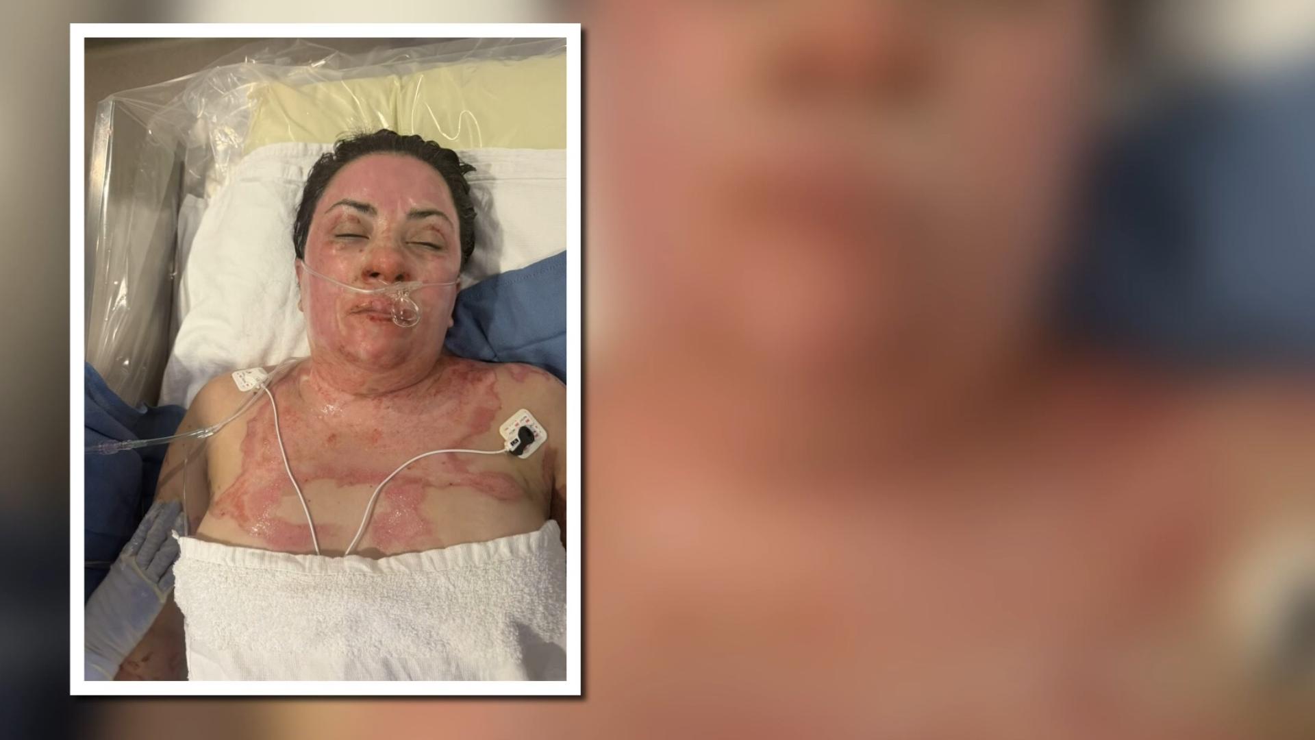 Colorado woman hospitalized after recalled tabletop firepit malfunctions