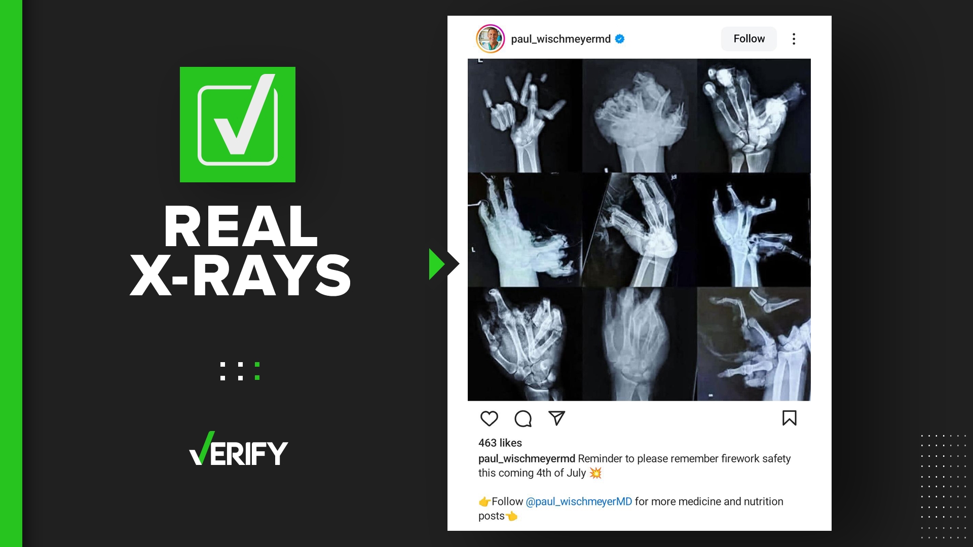 Hand X-ray photo shows what real firework hand injuries look like ...